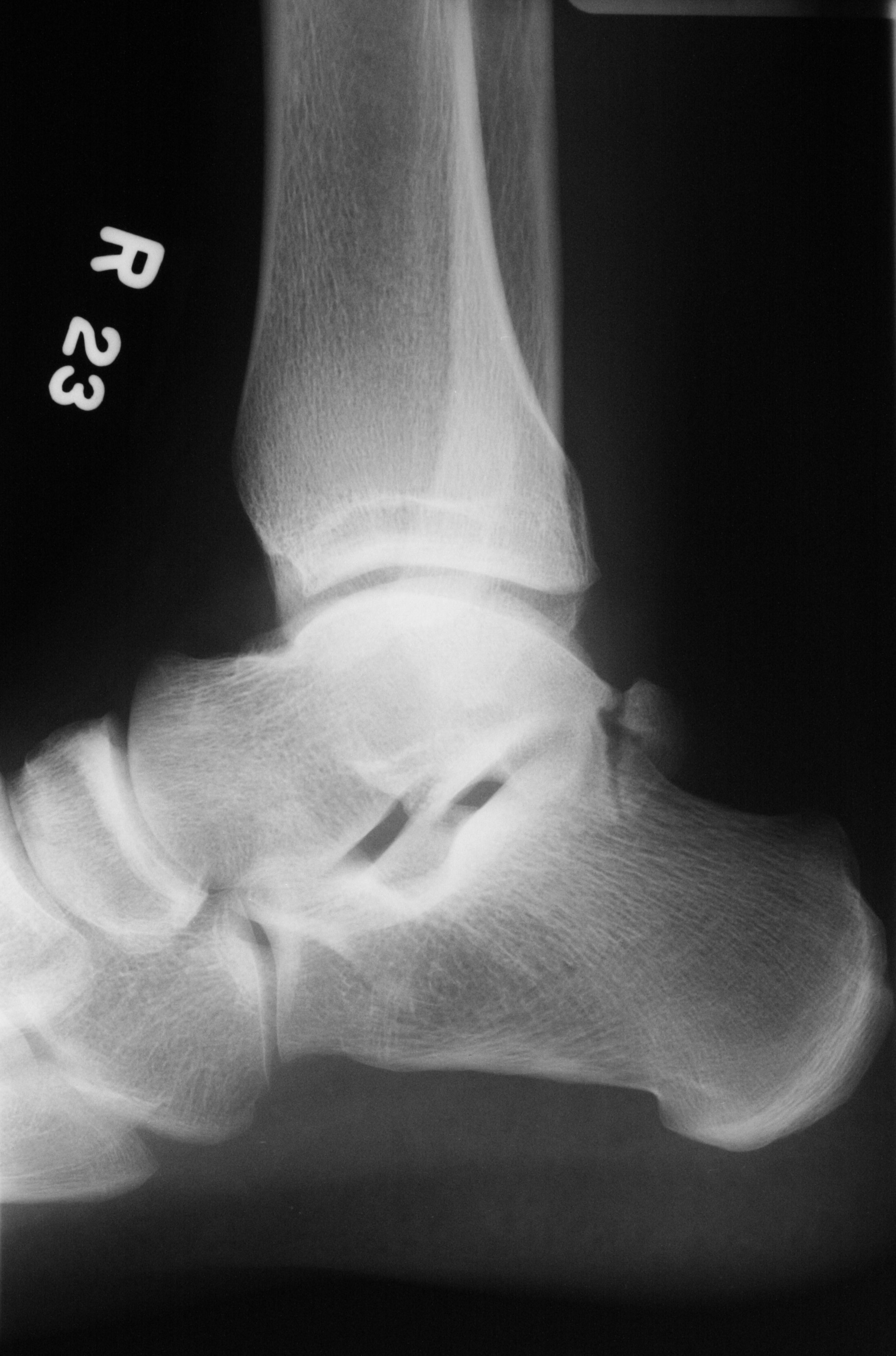 Right Accessory Navicular Excision